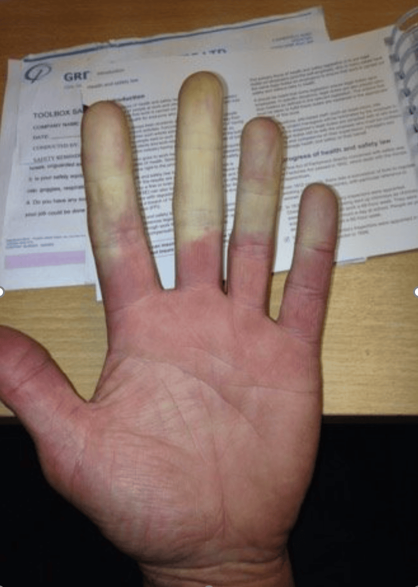 Hand Arm Vibration Syndrome